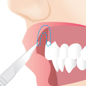 ガミースマイル手術
