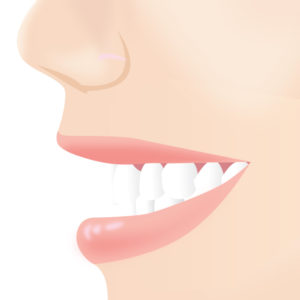 ガミースマイル手術