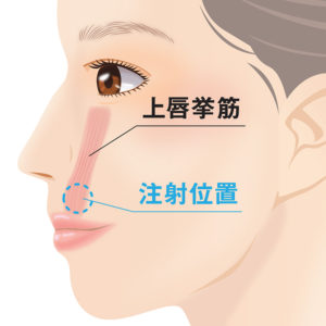 ガミースマイル手術