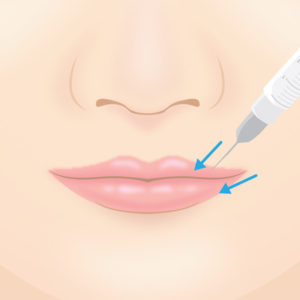 口唇増大術