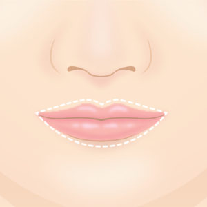 口唇増大術