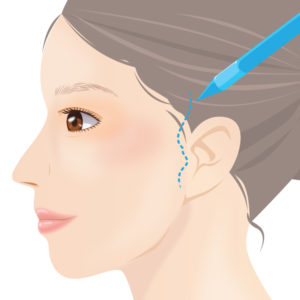 ミニフェイスリフト マーキング