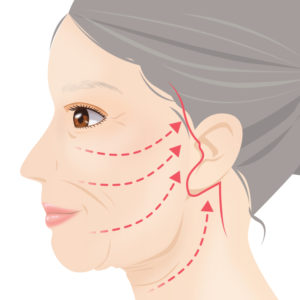 フルフェイスリフトとは