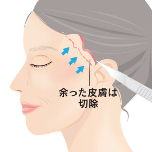 こめかみリフト