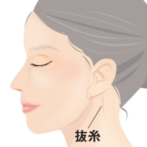 抜糸フルフェイスリフト