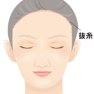 額リフト抜糸