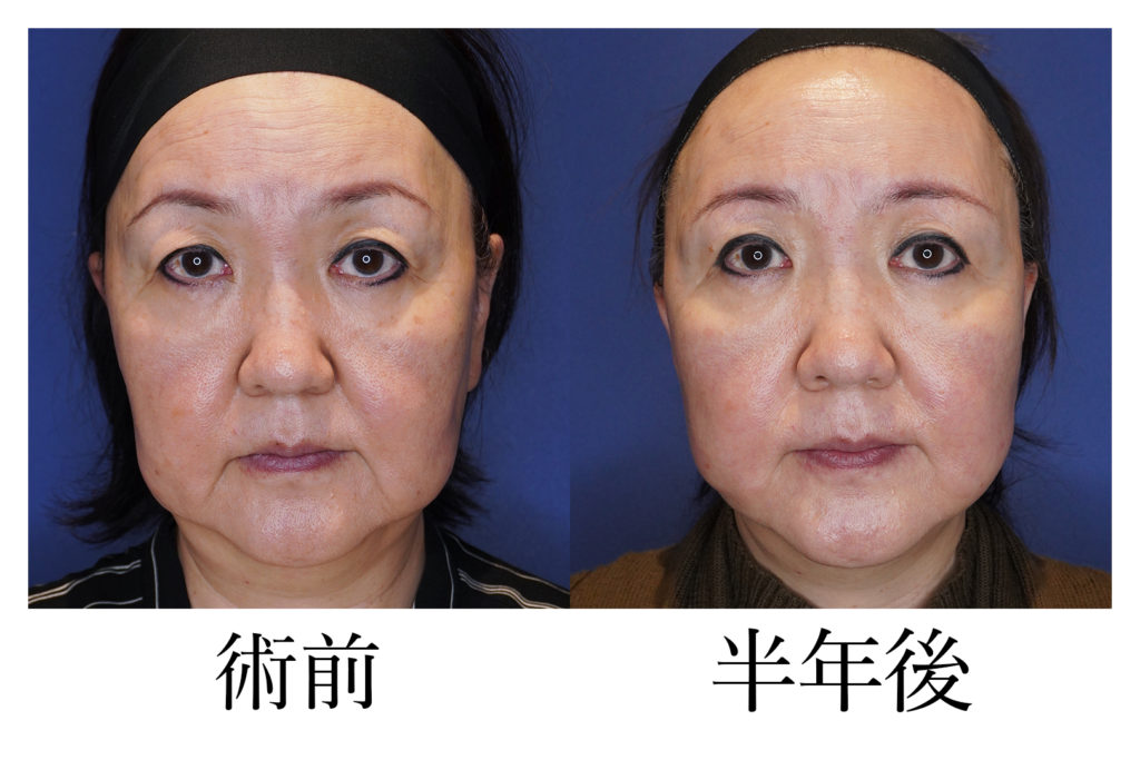 フルフェイスリフトアップ