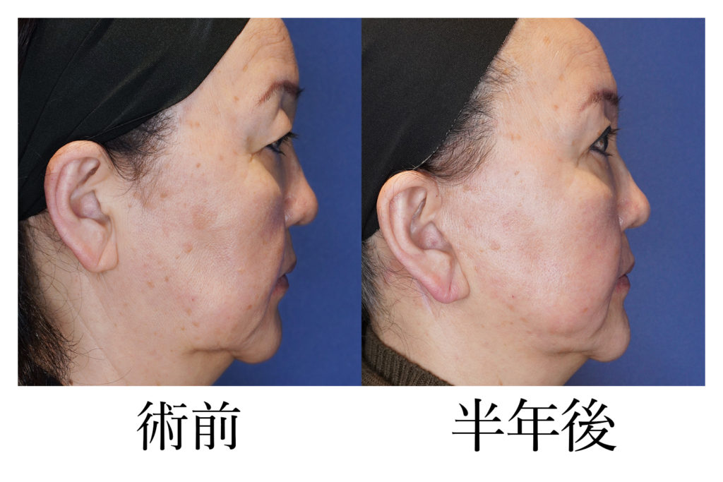 切開フルフェイスリフトアップ