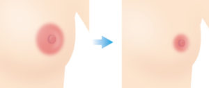 乳輪縮小とは