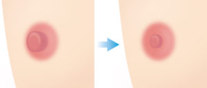 乳頭縮小（乳頭縮小とは）