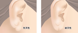 ピアス裂け修正（先天性・後天性）