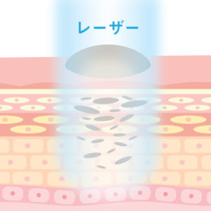ほくろ・イボ除去