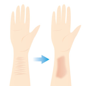 傷跡修正について