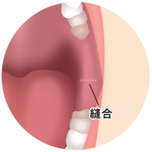 バッカルファット