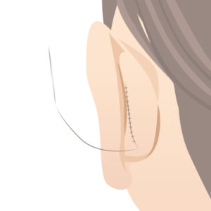 折れ耳縫合