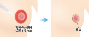 乳輪縮小（手術・乳輪外側を切開）