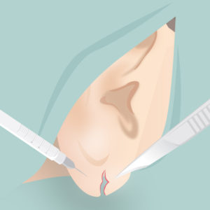ピアス裂け修正（麻酔・手術）