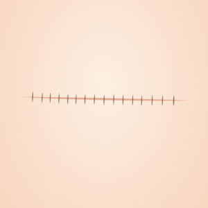 ほくろ・イボ除去