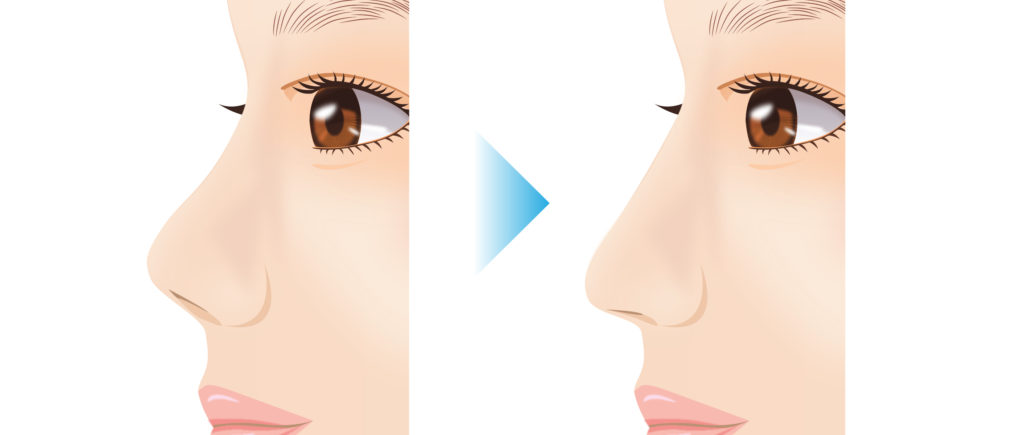 鼻孔縁挙上術の効果について