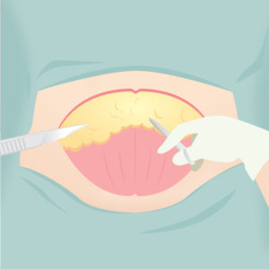 腹部切除・臍形成（タミータック）