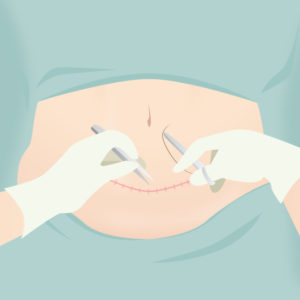 腹部切除・臍形成（タミータック）