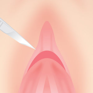 クリトリス包茎 麻酔、手術、縫合