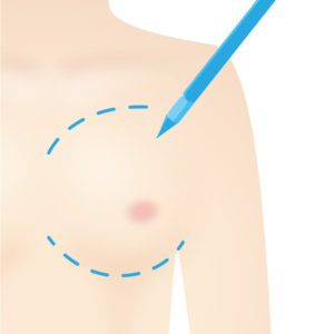 脂肪注入豊胸術｜マーキング・デザイン