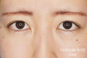 二重まぶた埋没法 施術後