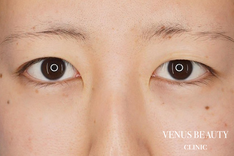 二重まぶた埋没法 施術前