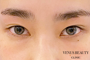 二重まぶた埋没法 施術前