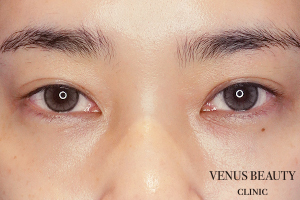 二重まぶた埋没法 施術後