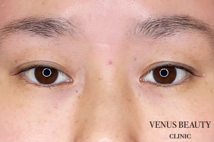 二重まぶた埋没法 施術前
