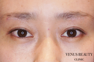 二重まぶた埋没法 施術後