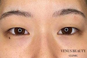 二重まぶた埋没法 施術前