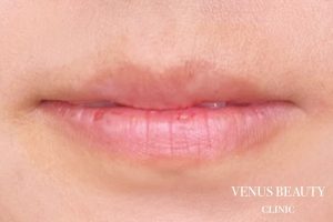 リップアートメイク 施術前