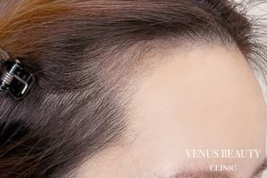 ヘアアートメイク症例一覧 施術後