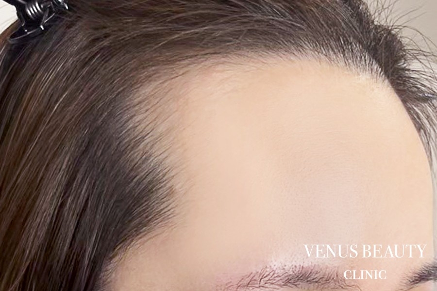 ヘアアートメイク症例一覧 施術前