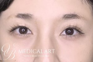 眉アートメイク症例一覧 施術前