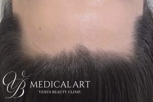 ヘアアートメイク症例一覧 施術前