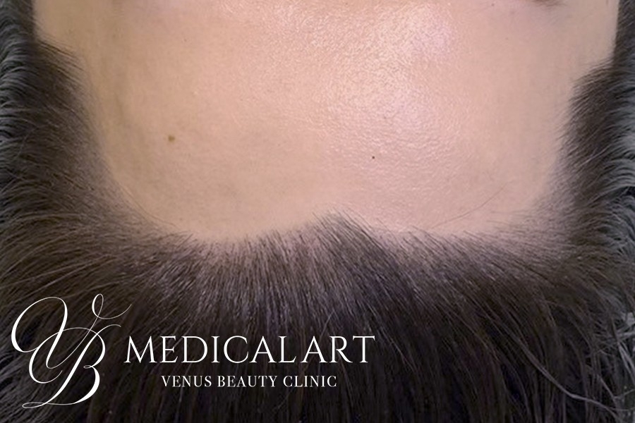 ヘアアートメイク症例一覧 施術後