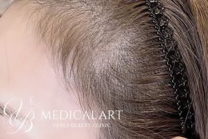 ヘアアートメイク症例一覧 施術後