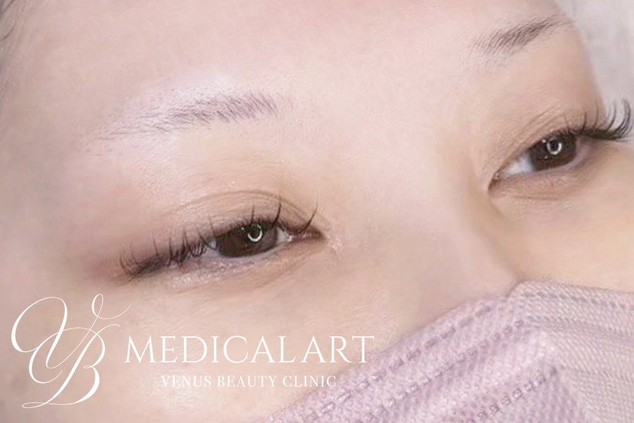 眉アートメイク症例一覧 施術前