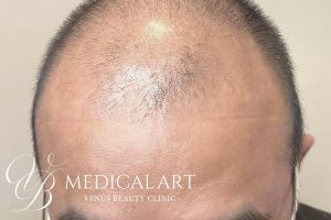 ヘアアートメイク症例一覧 施術前