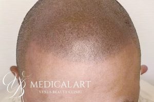 ヘアアートメイク症例一覧 施術後