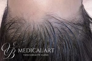 ヘアアートメイク症例一覧 施術前