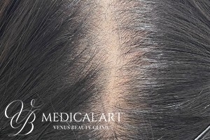 ヘアアートメイク症例一覧 施術前