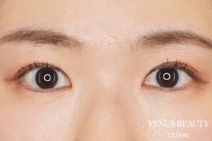 二重まぶた埋没法 施術後