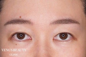 眉下切開(眉下リフト) 施術前