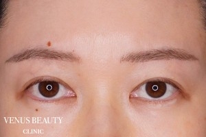 眉下切開(眉下リフト) 施術後