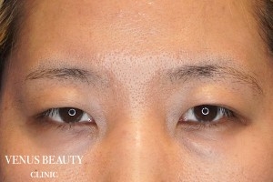 眼瞼下垂症 施術前
